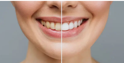 Dentist Mount Barker’ How Professional Teeth Whitening Treatments Can Transform Your Smile Safely and Effectively