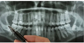 Wisdom Teeth Removal Adelaide’ OPG X-Rays & Surgical Timelines in Mount Barker